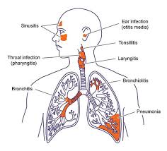 Respiratory Tract Infection Rti Is Defined As Any Infectiou Upper Respiratory Tract Infection Lower Respiratory Tract Infection Upper Respiratory Infection