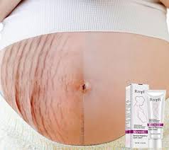 Pin On Stretch Marks Before And After