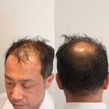 m字ハゲを自然に隠す髪型16選 男の薄毛を熟知した美容師のヘアカタログ aga エージーエープラス 薄毛 外国人風 パーマ メンズヘアカット