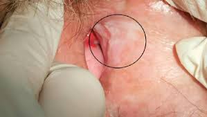 Image result for Vulvar Cancer