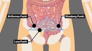 Unterbauch und ist mit einer länge von 6 bis 8 zentimetern nicht besonders groß. Blinddarmentzundung Ursache Symptome Und Behandlung Einer Appendizitis