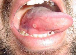 Eine aphthe ˈaftə (transliteration von altgriechisch ἄφθη, vom verb ἅπτω haptō, deutsch ‚entfachen') ist eine schmerzhafte, von einem entzündlichen randsaum umgebene schädigung der schleimhaut des zahnfleischs, der mundhöhle einschließlich der lippen, der tonsillen oder der zunge. Bilder Von Aphten An Verschiedenen Stellen Im Mund Wefix