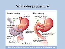 Pin By Waarda Mohamed On Medical Professionalism Whipple Procedure Medical Pictures Medical