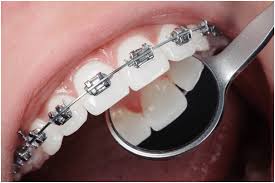 Does Dental Insurance Cover Braces? – Forbes Health