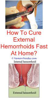 How long do hemorrhoids take to shrink? How Long Does A Thrombosed Hemorrhoid Take To Go Away Hemorrhoids Treatment Hemorrhoids External Hemorrhoids