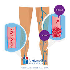 La trombosis es la formación de un coágulo en el interior de un vaso sanguíneo y uno de los causantes de un infarto agudo de miocardio.también se denomina así al propio proceso patológico, en el cual, un agregado de plaquetas o fibrina obstruye un vaso sanguíneo. Pin En Trombosis