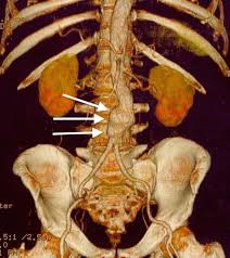 Aneurisma aorta addominale, intervento endovascolare eseguito dal prof. Aneurisma Dell Aorta Addominale Wikipedia