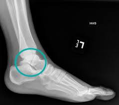 Image result for Talus Fracture