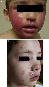 Recent insights into atopic dermatitis and implications for management of  infectious complications