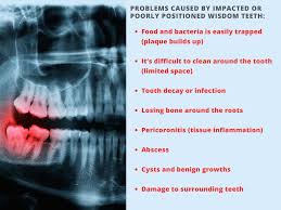 Typically wisdom teeth will be removed in an office, but in some cases the procedure might be done which tooth/teeth: Wisdom Teeth Removal Dr Alistair S Comprehensive Guide
