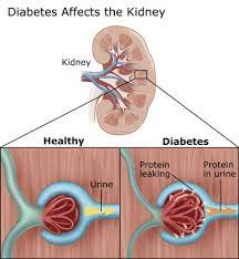 Signs and symptoms of kidney failure include Kidney Complications Diabetes Education Online