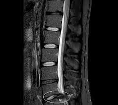 Bandscheibenvorfall Symptome Diagnose Therapie Reha