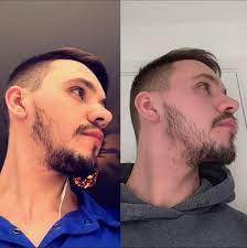 Minoxidil can stimulate the hair follicles on your face, improving circulation. Minoxidil Guide For Thicker Beard Facial Hair And Fuller Eyebrows