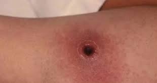 Image result for Anthrax