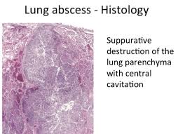 Check spelling or type a new query. Pathology Modules Lung 1 2 And Head And Neck Flashcards Quizlet
