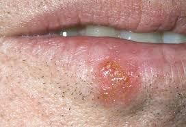 Weak bones that are more likely to fracture. Mouth Throat Cancer Pictures Treatment Signs Stages Symptoms