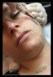 10 Dermaplaning ideas