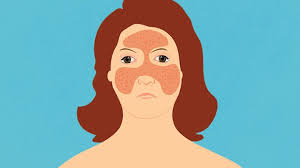 Topsearch.co updates its results daily to help you find what you are looking for. How To Identify Rashes And Other Lupus Skin Symptoms Everyday Health