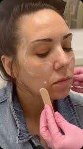 Say hello to natural, long-lasting volume with Sculptra! ✨ Unlike  traditional fillers, Sculptra stimulates your body’s own collagen  production, gradually restoring lost facial volume and improving ...