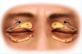 Image result for xanthelasma of eyelid
