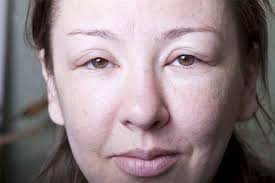 Image result for Angioedema