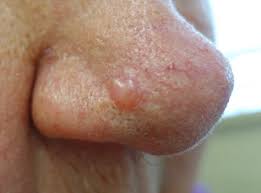 Basal cell carcinoma is the most common form of skin cancer, and least dangerous whereas melanoma (often referred to as. Nonmelanoma Skin Cancer Facial Plastic Surgery Clinics