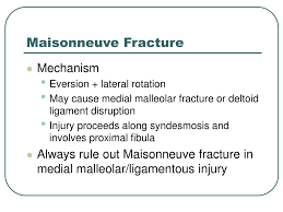 The maisonneuve fracture results from an ankle eversion injury. Ppt An Approach To Ankle X Rays Powerpoint Presentation Free Download Id 6759981