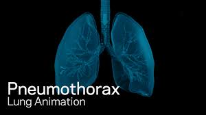 Pneumothoraces can be even further classified as simple, tension, or open. Pneumothorax Youtube