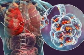 Decisions about testing are made by state and local health departments or healthcare providers. Goriau Jangan Panik Kenali Tanda Tanda Virus Corona Atau Pneumonia Wuhan