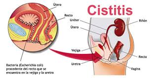 Informacion Sobre La Cistitis Infeccion Urinaria Askabide
