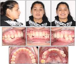 The disease was first reported in 1933 1. Orthodontic Management Of A Patient With Cherubism A Case Report American Journal Of Orthodontics And Dentofacial Orthopedics