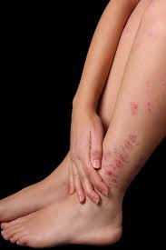 Dermatita De Staza Imagini Wasatchpremiermovers Com