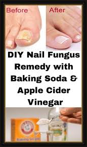 Consult your doctor before taking any herbal solution or medicine, especially if you are pregnant or breastfeeding mother or are on medication for heart, diabetes or any. Diy Nail Fungus Remedy With Baking Soda Apple Cider Vinegar Nail Fungus Remedy Apple Cider Vinegar Health Nail Fungus