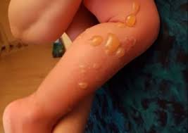 Kak Lechit Ozhogi I Uskorit Ih Zazhivlenie Effektivnye Sredstva V Domashnih Usloviyah