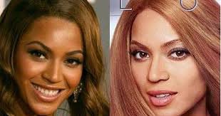 Black And White Bleaching Cream Results Pin On Skin Bleaching