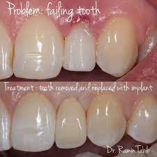 Nyc Smile Design On Instagram Here Is A Case Of A Failing Tooth That Needs To Be Replaced With An Implant Very Challenging Situation Anytime You Have To Re