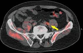 Being armed with information is vital to begin the fight. Fluciclovine Pet Ct Locates Recurrent Prostate Cancer And Advises Management
