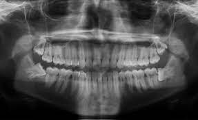 This passage way becomes a breeding ground for bacteria. Impacted Wisdom Teeth Removal East London South Africa Dr Herman Kruger