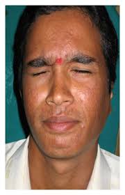 Complete recovery of facial palsy at 3 month follow-up.