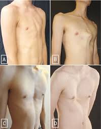 Pectus excavatum and carinatum support, photos, community, forum. Pectus Updates And Special Considerations In Marfan Syndrome Abstract Europe Pmc