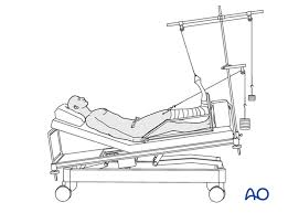 A) bucks traction b) bryant's traction (left) 15 degrees of the bed for best results. External Fixation And Traction For Iliac Fractures