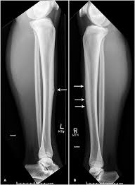Image result for Tibia Stress Fracture