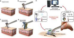 He or she inserts the implant electrodes into the cochlea. Bioresorbable Electronic Implants History Materials Fabrication Devices And Clinical Applications Cha 2019 Advanced Healthcare Materials Wiley Online Library