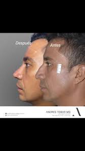 RINOPLASTIA ANDRÉS TOBAR PADILLA MD Cirujano Plástico Reconstructivo y  Estético 👃🏻👱🏼‍♀️ Cirugia Plastica facial 💉👄Botox y ácido hialuronico  👙👙Cirugía Plástica Corporal #rinoplastiadrtobar #rinoplastia ...