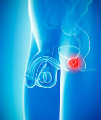 Treatments for advanced prostate cancer focus on managing symptoms and slowing the growth and spread of the cancer. Prostate Cancer Symptoms And Signs Look For This When You Urinate Express Co Uk