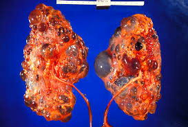 Your kidneys filter wastes and excess. Autosomal Dominant Polycystic Kidney Disease Wikipedia