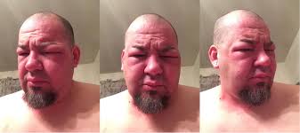 My left eye swelled completely shut. I wasn't crying