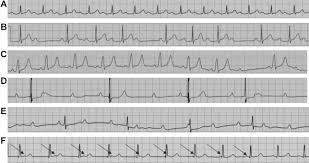 Image result for Atrioventricular Block