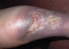 Ulcus Cruris Offenes Bein Ursachen Diagnose Therapie Prognose