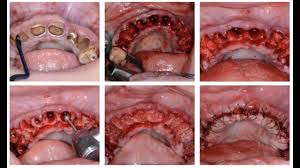 · precautions that should always be taken after the procedure. Webinar Full Mouth Extractions In One Appointment Dr Nazarian May 7 2019 Youtube